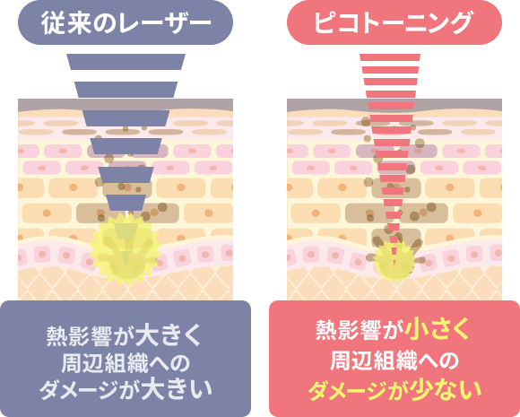 従来のレーザーとピコトーニングの比較